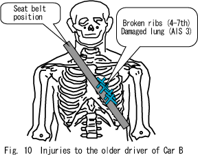 Fig. 10  Injuries to the older driver of Car B